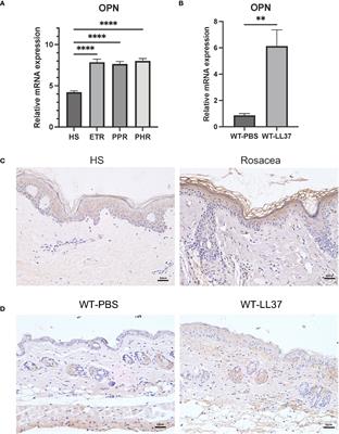 OPN promotes pro-inflammatory cytokine expression via ERK/JNK pathway and M1 macrophage polarization in Rosacea